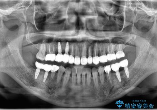 虫歯・噛み合わせ・インプラント、全顎総合治療