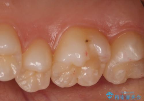奥歯の保険の詰め物を自費のものに変えたいの治療前