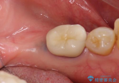 70代女性 段差のある被せ物のやり替え の治療前
