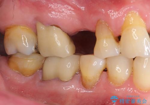 失った奥歯のインプラント治療の治療前