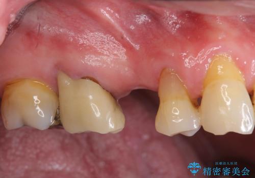 失った奥歯のインプラント治療の症例 治療前
