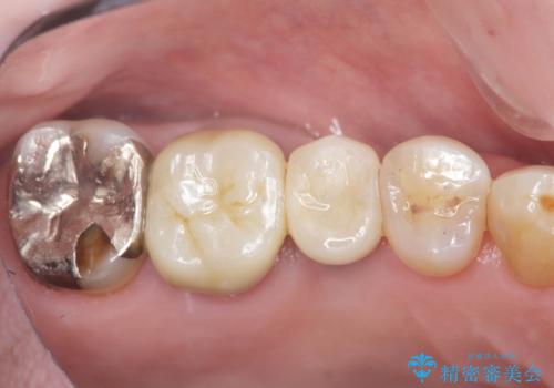 失った奥歯のインプラント治療の治療後