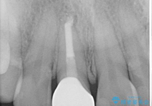 根管治療と並行して矯正を マウスピース治療の治療後