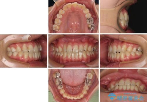 マウスピース矯正が煩わしい　ワイヤー装置での非抜歯矯正の治療前