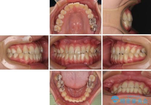 マウスピース矯正が煩わしい ワイヤー装置での非抜歯矯正の治療前