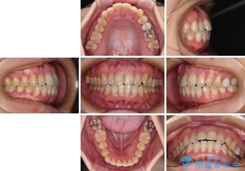 抜歯矯正 ワイヤー装置で横顔の印象を改善の治療前