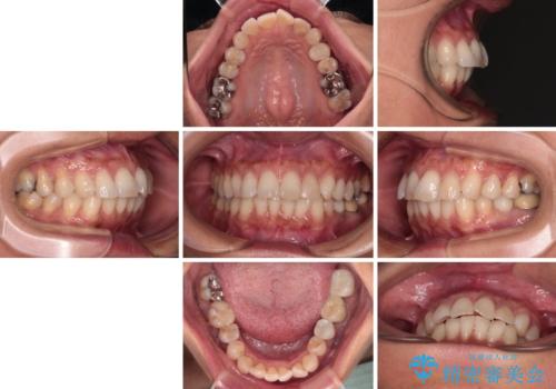 むし歯と前歯のデコボコを治したい　インビザラインを使用した総合歯科治療の治療前