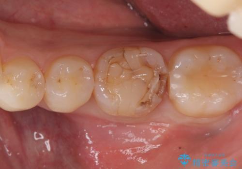 【セラミッククラウン】歯がポロポロ欠けたの治療前