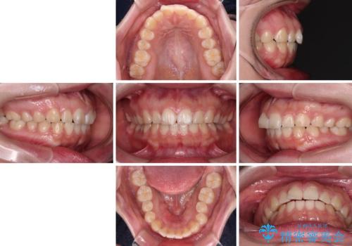 口元の突出感を治したい ワイヤー装置を用いた抜歯矯正の治療前