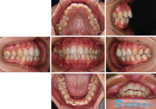 前歯のデコボコを改善　インビザラインの矯正治療の治療前