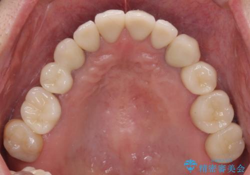 虫歯・噛み合わせ・インプラント、全顎総合治療の治療後
