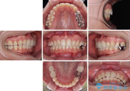 気になる出っ歯を治したい　ワイヤー装置の抜歯矯正でスッキリした横顔にの治療後