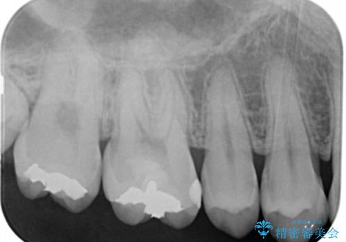 銀歯を白くしたい フルジルコニアクラウンとセラミックインレーの治療前