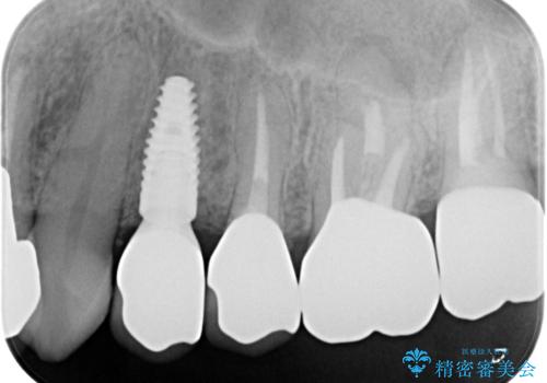 破折歯のインプラント治療、奥歯の根管・セラミック治療