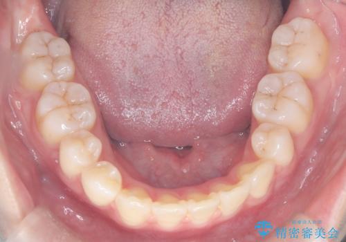 ハーフリンガル矯正|下顎前歯3本の特異症例を抜歯矯正で改善の治療後
