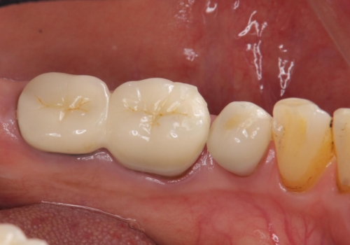 70代女性 状態の悪い歯を抜歯して、奥歯をブリッジにの治療前