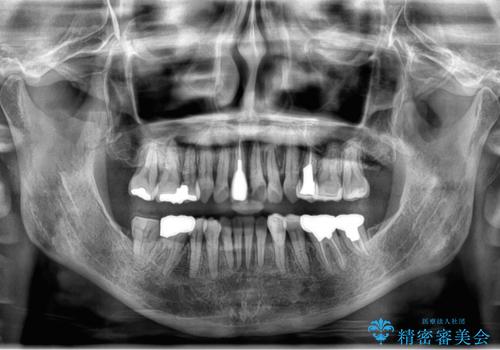 50代女性　八重歯を矯正治療　歯並びの中等度のがたつきの治療後