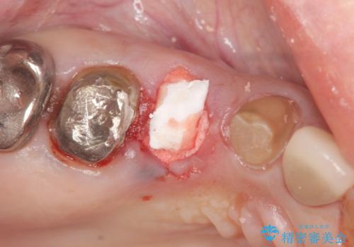 歯槽堤保存を併用し清掃性を高めたブリッジ治療の治療中