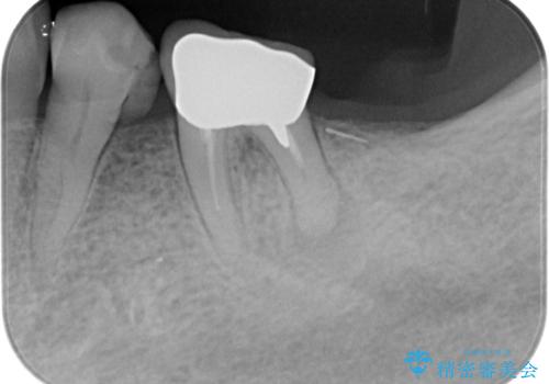70代女性 段差のある被せ物のやり替え の治療前