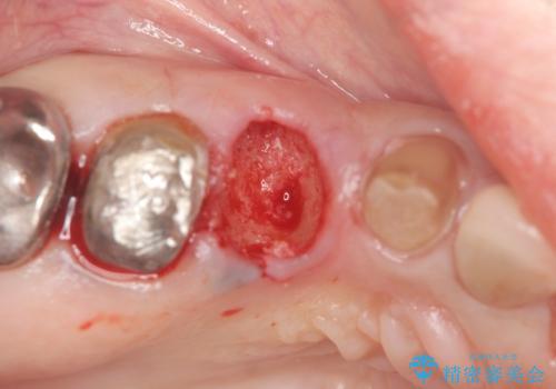 歯槽堤保存を併用し清掃性を高めたブリッジ治療の治療中