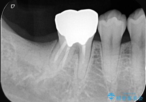 歯のインプラント治療|1回の手術で負担を軽減し、自然な噛み心地を再現の治療前