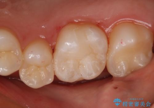 奥歯の保険の詰め物を自費のものに変えたい