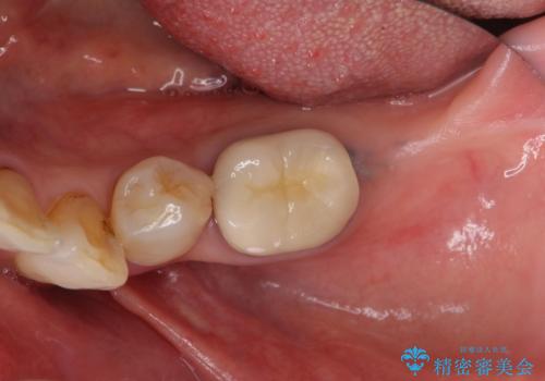 70代女性 段差のある被せ物のやり替え の治療前