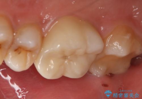 銀歯を白くしたい フルジルコニアクラウンとセラミックインレーの治療後