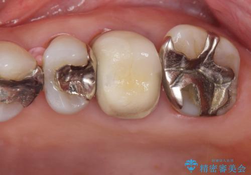 70代女性 段差のある被せ物のやり替え の治療前