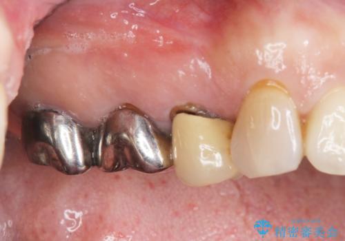 歯槽堤保存を併用し清掃性を高めたブリッジ治療の症例 治療前