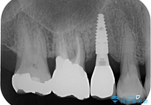 失った奥歯のインプラント治療の治療後