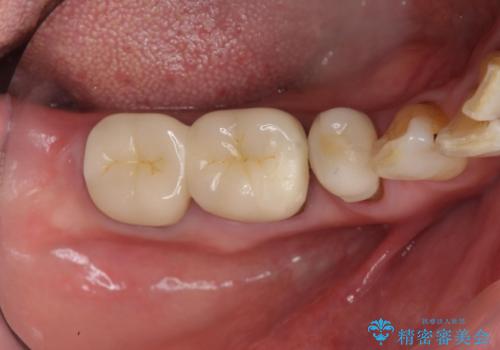 70代女性 状態の悪い歯を抜歯して、奥歯をブリッジにの治療前
