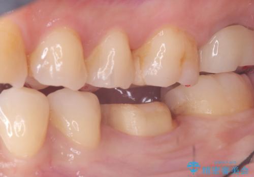 【セラミッククラウン】歯がポロポロ欠けたの治療中