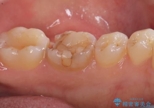 【セラミッククラウン】歯がポロポロ欠けたの治療前