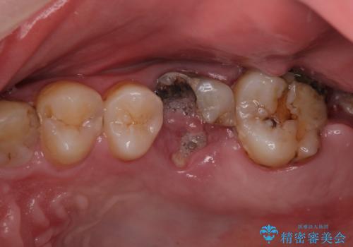 全部治療して見た目を良くしたい。の治療前