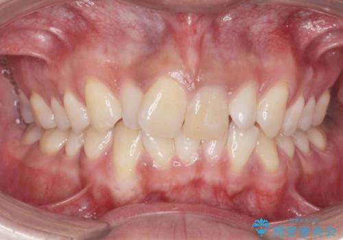 [マウスピース矯正]  海外留学中でも可能な矯正治療の治療前