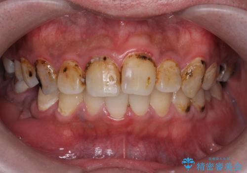 全部治療して見た目を良くしたい。の治療前