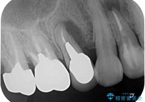 歯槽堤保存を併用し清掃性を高めたブリッジ治療の治療前