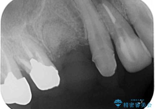 歯槽堤保存を併用し清掃性を高めたブリッジ治療の治療中