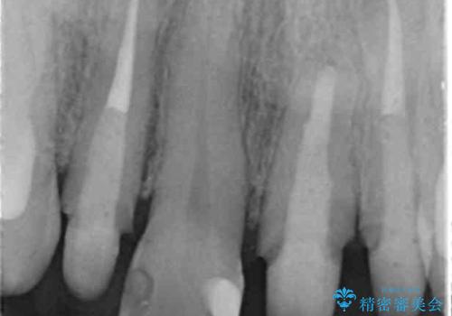 前歯のフチが黒いのが気になる 前歯のセラミック治療の治療中