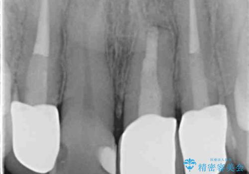 前歯のフチが黒いのが気になる 前歯のセラミック治療の治療後