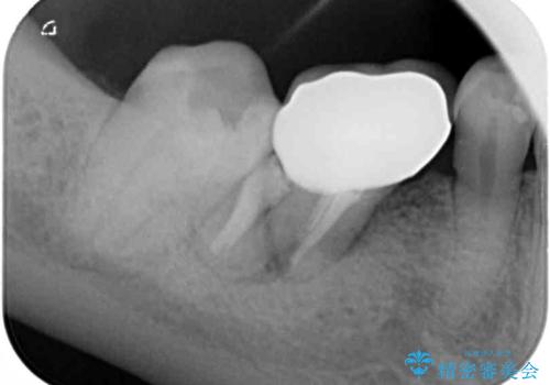 割れてしまった奥歯 インプラントによる補綴治療の治療前