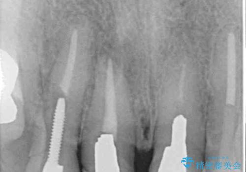割れてしまった歯と深いむし歯 部分矯正と外科処置で安定したブリッジ治療の治療前