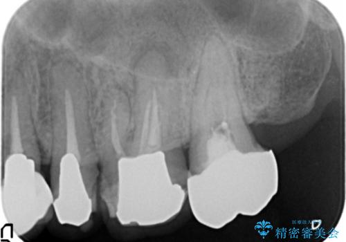 破折歯のインプラント治療、奥歯の根管・セラミック治療の治療前