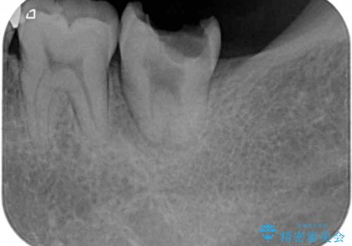 伸び出してきた上顎奥歯 部分矯正を用いた奥歯の補綴治療の治療前