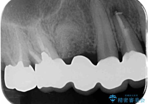歯槽堤保存を併用し清掃性を高めたブリッジ治療の治療後