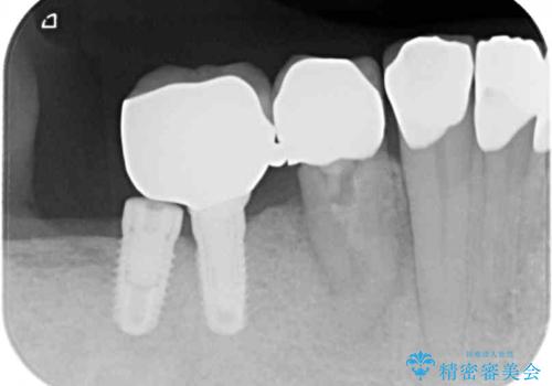 強い咬合力で歯が割れる 1DAYインプラントで歯を守りながら治療の治療前