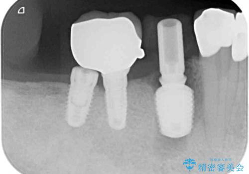 強い咬合力で歯が割れる 1DAYインプラントで歯を守りながら治療の治療中