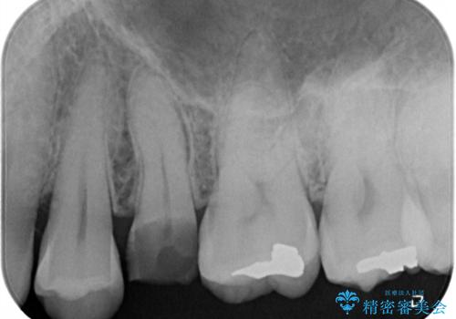 放置していたむし歯　抜歯即時埋入インプラントで負担を軽減の治療前