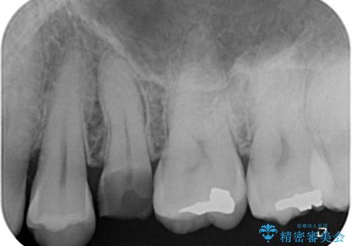 放置していたむし歯 抜歯即時埋入インプラントで負担を軽減の治療前